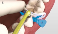 Palodent V3 matrix plaatsen met klempincet