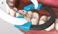 Een Palodent V3 ring plaatsen