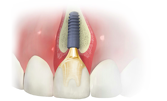 Long term hard and soft tissue stability