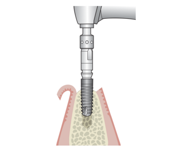 Placing the implant motorized or manual