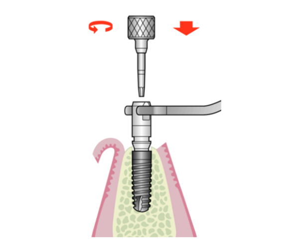 Disassembly of implant driver and placement head