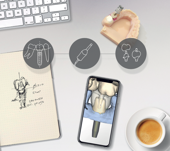 Digital Implant Workflow