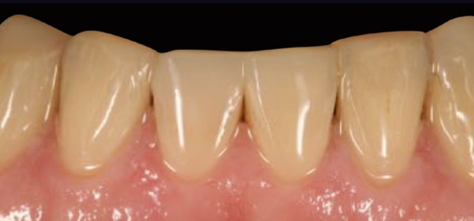 After restoration with ceram
