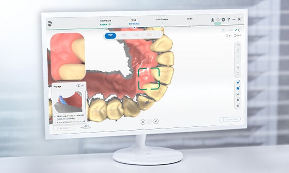 IntraoralScan Software on a monitor