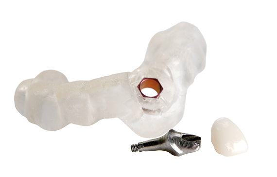 Immediate Smile featuring Atlantis Abutment