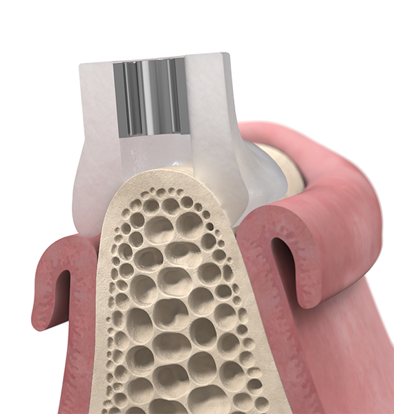 Bone-supported Simplant Guide