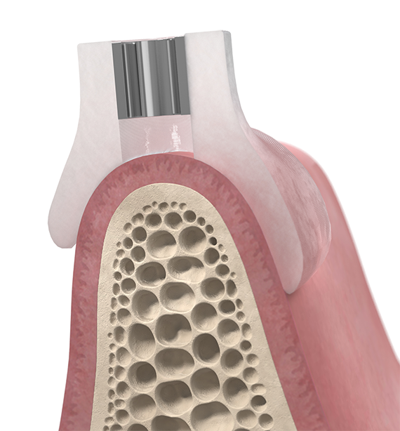 Mucosa-supported Simplant Guide