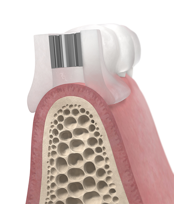 Tooth-supported Simplant Guide